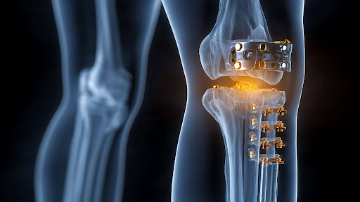 Knee Implants